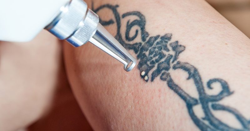 Tattoo Removal at Rethink Me - Transform Your Skin Today!