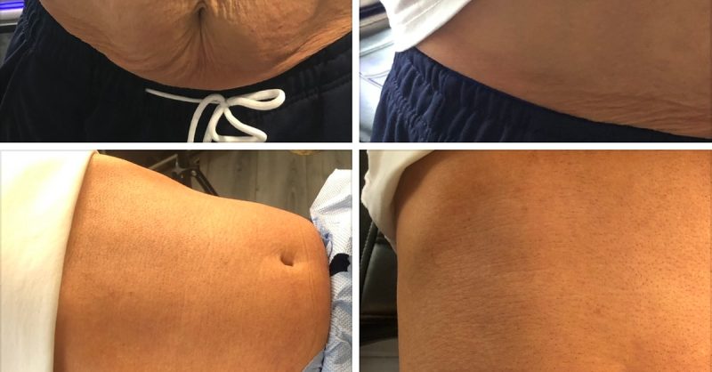 Lift and Tighten Your Face, Neck, or Stomach at Entwined Tattoo And Aesthetics