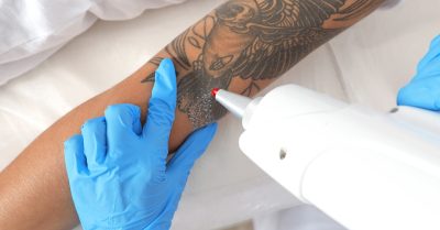 Tattoo Removal at Haus of Skin