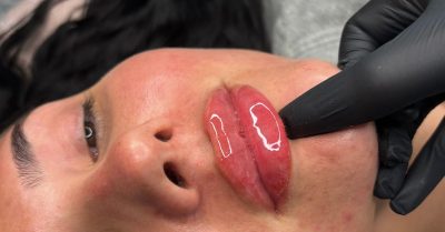 Dermal Filler Injection at Perfection Clinic
