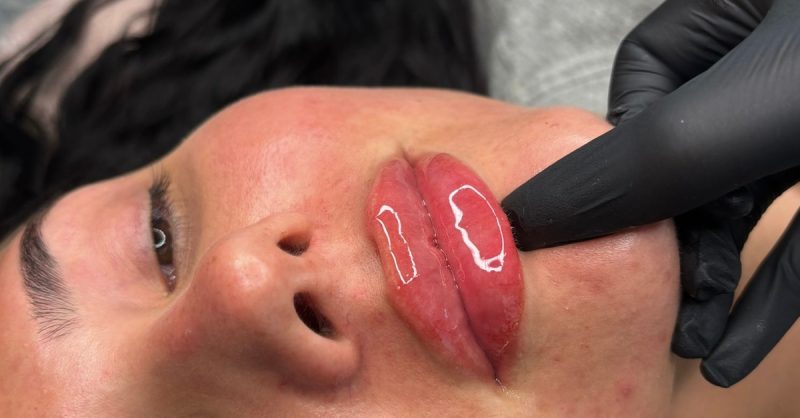 Dermal Filler Injection at Perfection Clinic