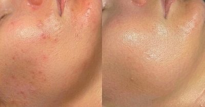 Medical MicroNeedling at The Luminary Clinic