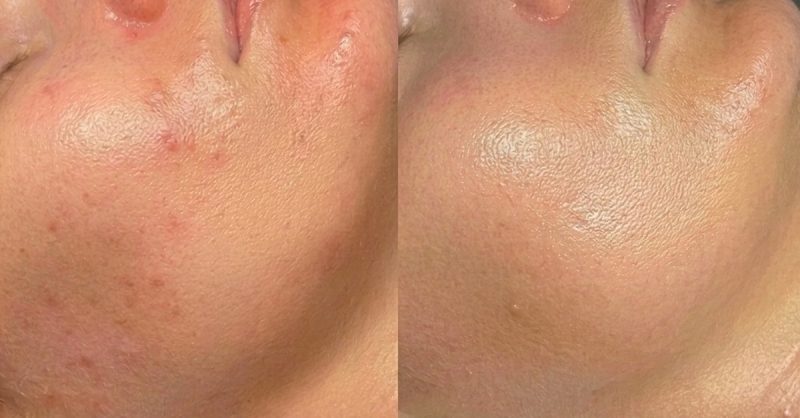Medical MicroNeedling at The Luminary Clinic