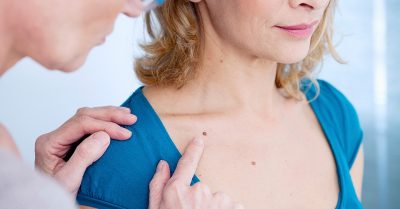 Mole and Growth Removal at Beauty Aesthetics & Wellbeing Clinic