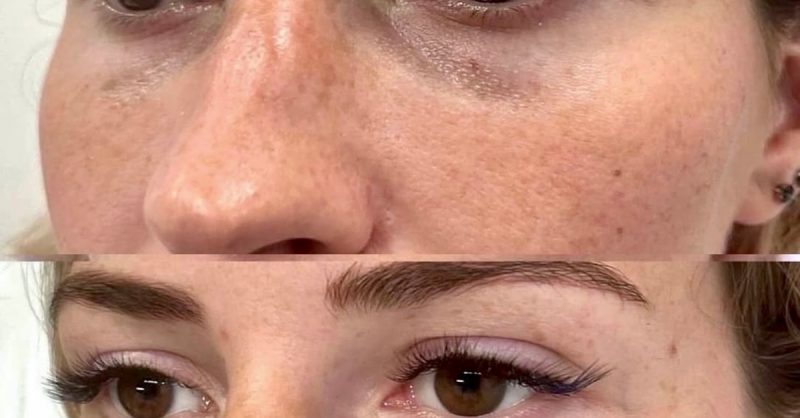 Revitalize Your Look with Dark Circle Treatment at Aesthetic Zone