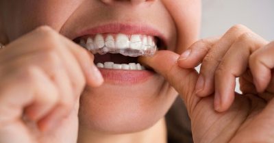 Achieve Your Perfect Smile with Invisible Aligners at AMC Dental