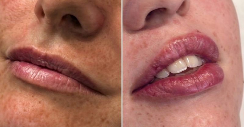 Lip Dermal Filler Treatment at Luxe Contour Aesthetics