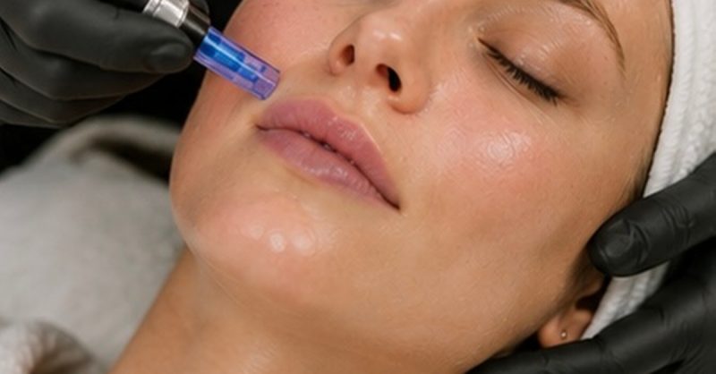 Microneedling or Dermaplaning Facials at Chic aesthetics london in Rye Lane