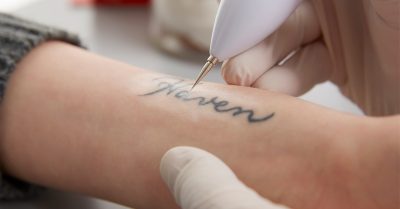 Tattoo Removal at Faded-ink for a Fresh Start