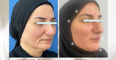 Transform Your Look with Dermal Fillers at Aesthetic and Beauty Consultants