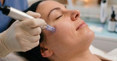 Microneedling Sessions at Jolacom Aesthetics Clinic for Skin Rejuvenation