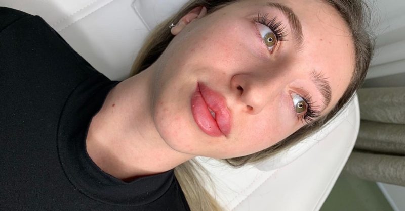 Lip Dermal Filler at Queen of Lips in Cavendish Square