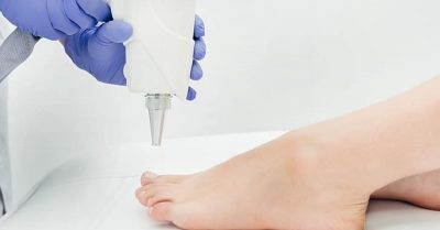 Laser Fungal Nail Removal at Haiir & Skiin
