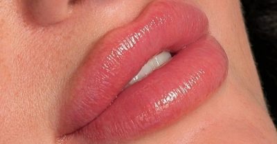 Dermal Filler Treatments at The haus of beauty and aesthetics
