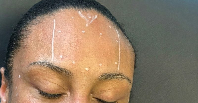 Smooth Skin Injections at Fabuluxe Aesthetics for a Refreshed Look