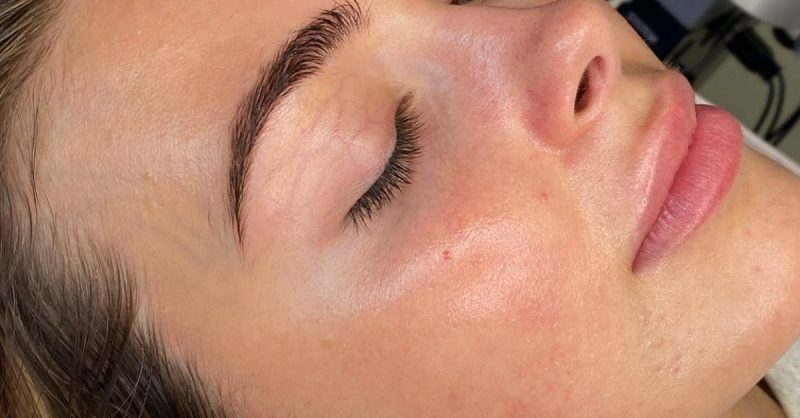 HydraFacial at Lash hq for a Refreshing Skin Treatment