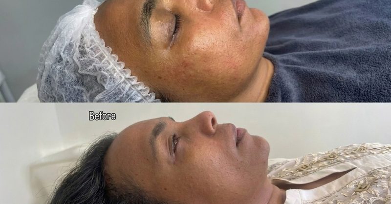 Hydrafacial Treatment at DermaDeluxe aesthetics london - 50 or 60 Minutes