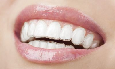 Invisible Braces for One or Both Arches at Highfield Avenue Dental
