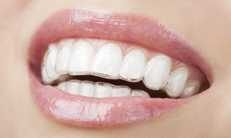 Invisible Braces for One or Both Arches at Highfield Avenue Dental