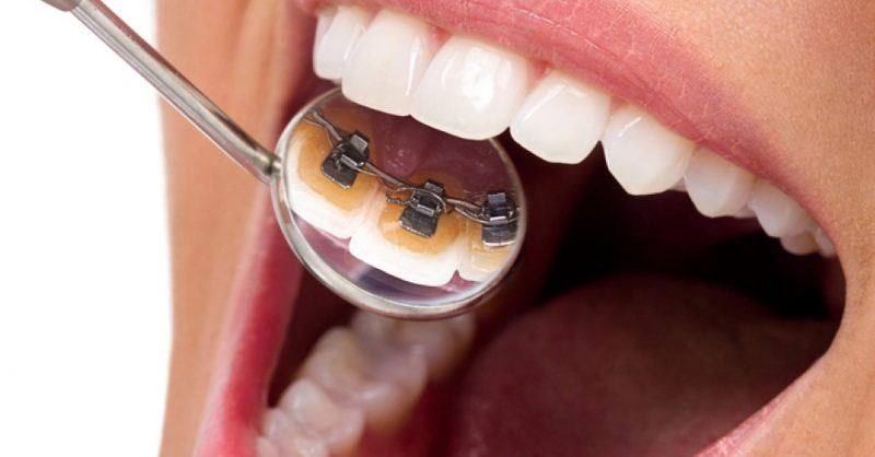 Lingual Braces for One or Two Arches at Dental Care London