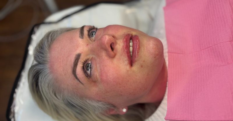 Lip Filler Treatments for Fuller Lips at The Skiin Hub By Nurse Lizzie