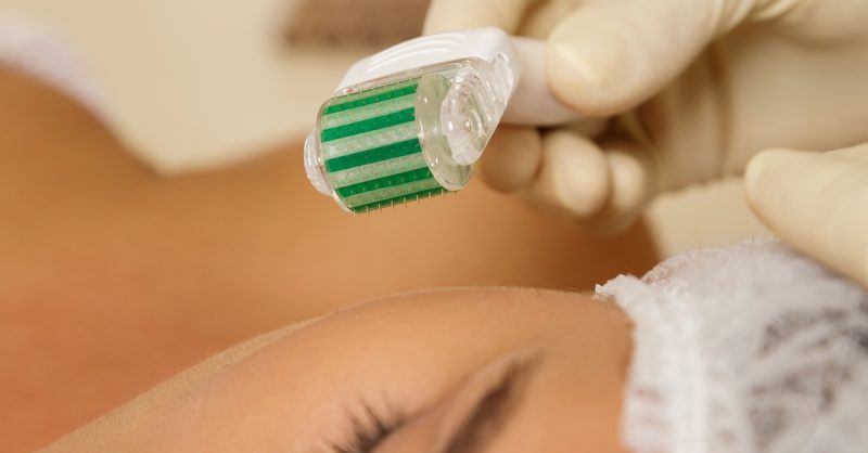 Microneedling Sessions for Radiant Skin at Beauty Inn Salon