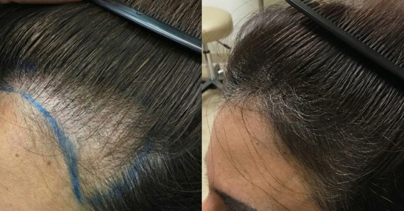 PRP Hair Restoration Treatments at Shamis Health & Beauty
