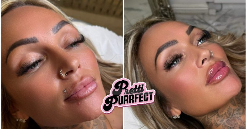 Dermal Filler Treatment at Pretti Purrfect