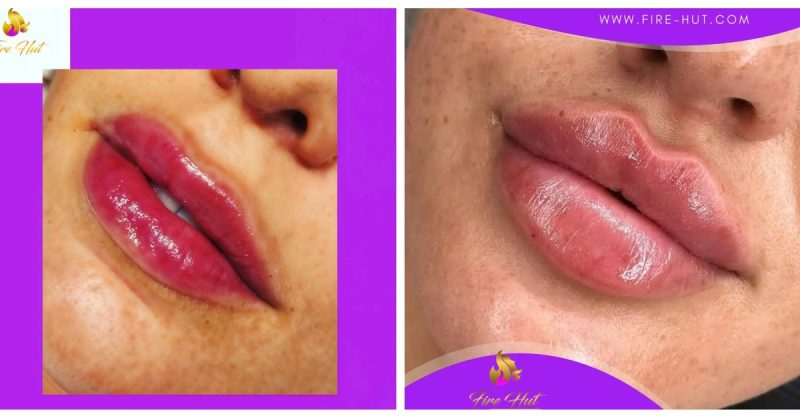 Dermal Filler Packages at FH for Beautifully Enhanced Features
