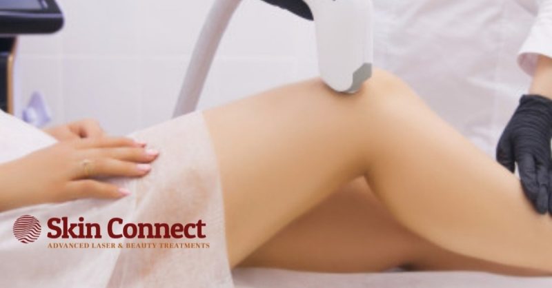 Laser Hair Removal Experience at Skin Connect