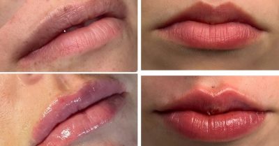 Dermal Lip Filler with Consultation at Cosmetic Enhancement Academy