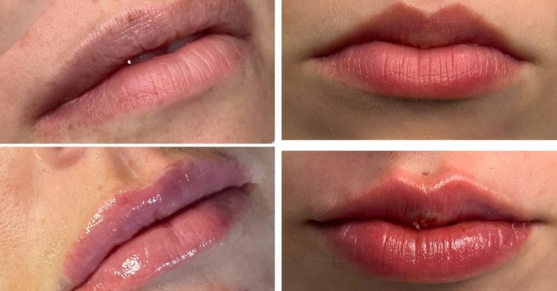Dermal Lip Filler with Consultation at Cosmetic Enhancement Academy