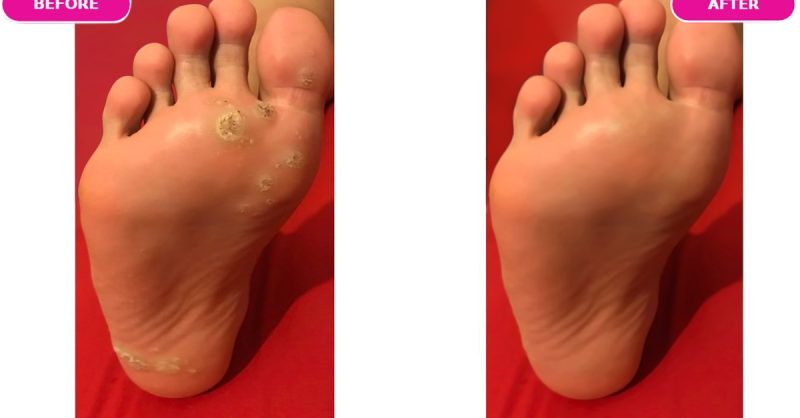 Cryosurgery Treatment for Warts at Raymond Nash