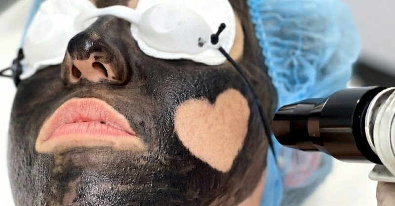 Luxury Carbon Facial at DA Laser Clinic for Radiant Skin