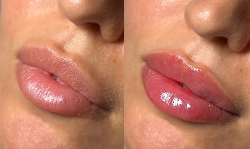 Dermal Fillers for Lips, Chin, Jawline at Method Aesthetics, London