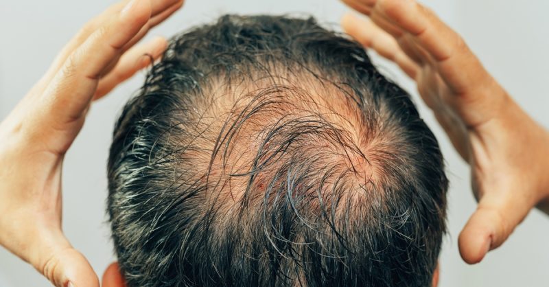 60-Minute Scalp Mesotherapy Treatment at Heaven Salon