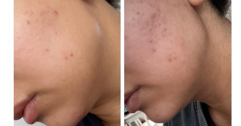 Premium Microneedling Facial Sessions at Peri Skin