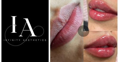 Dermal Filler Injection at Infinity Aesthetics London