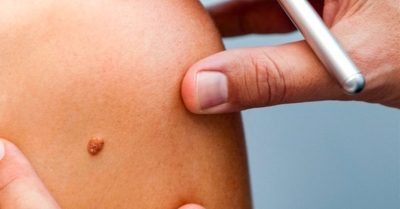 Skin Tag Removal Sessions at Aesthetic By Nurse