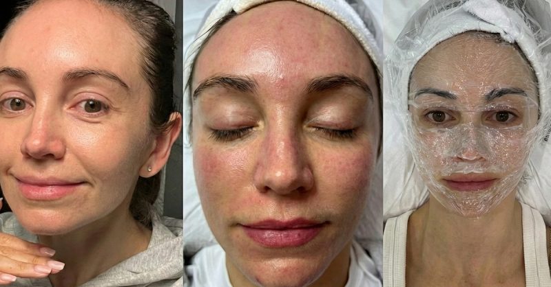 Medical Microneedling Facial with Hyaluronic Acid at Aesthetics bycoco