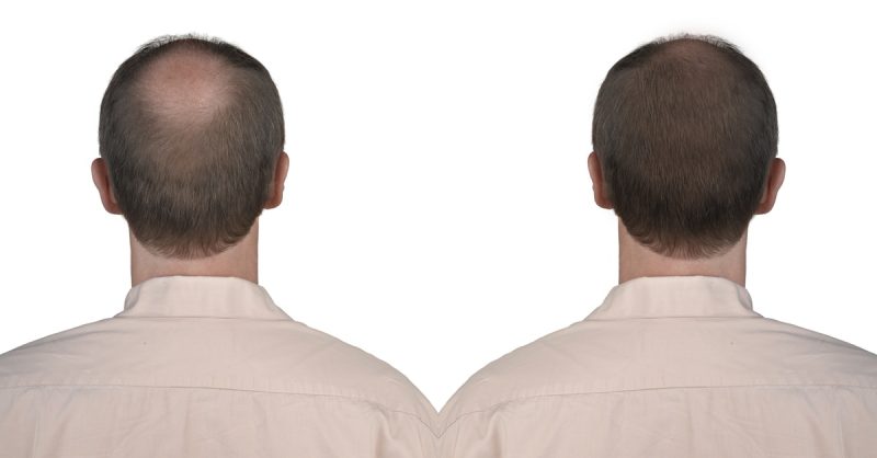PRP Hair Growth Stimulation with Consultation at Elite Skin