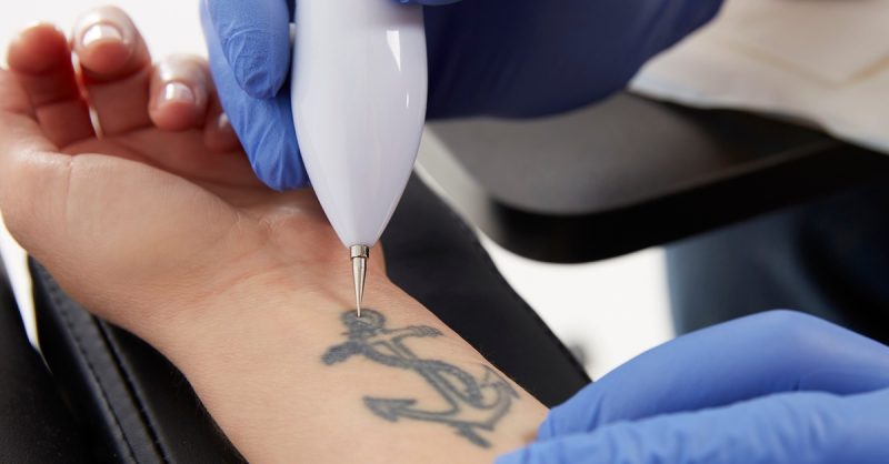 Tattoo Removal at 1118 Beauty Salon