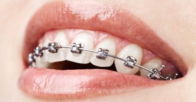 Expert Orthodontist Services at Ortho London