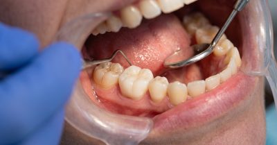 Dental Fillings at DentEuropa Implant and Orthodontic and Perio Centre in London