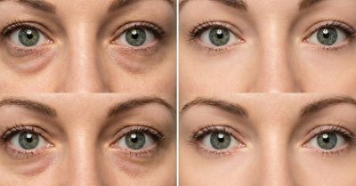 Polynucleotide Sessions with Skin Boosters at Aesthetics bycoco