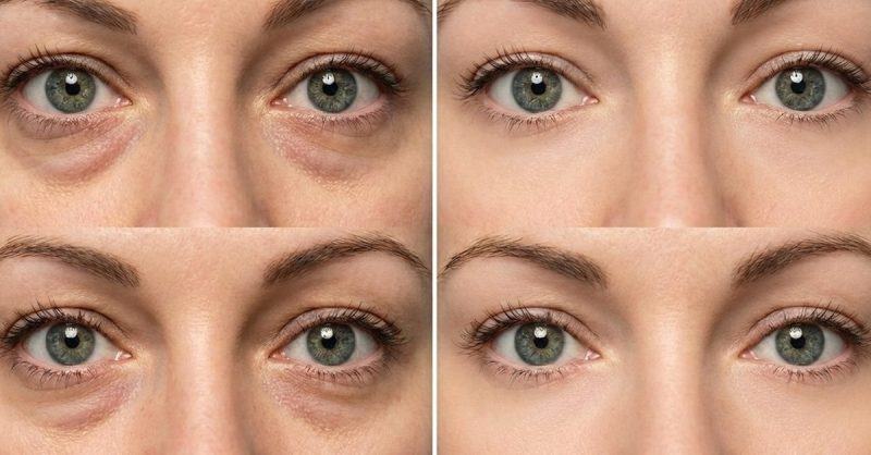 Polynucleotide Sessions with Skin Boosters at Aesthetics bycoco