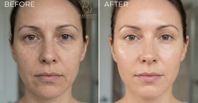 Aqualyx® Fat Dissolving Treatment at Dr Bennett Aesthetics Clinics
