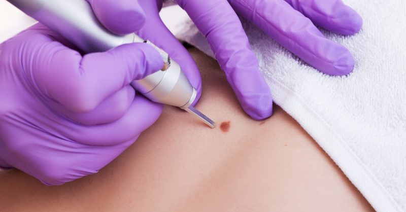 Threadvein and Skin Tag Removal at Olivia Gray