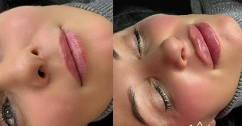 Enhance Your Lips with Dermal Fillers at Benson Beauty Aesthetics