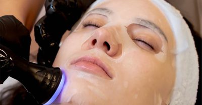 Microneedling Facial at Avant Skincare for Radiant Skin